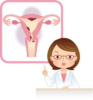 子宮がんの記事に関する挿絵